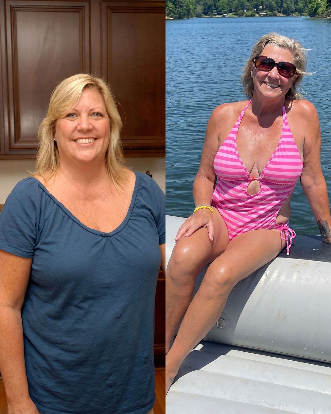 A weight loss patient before (left) and after (right) weight loss.