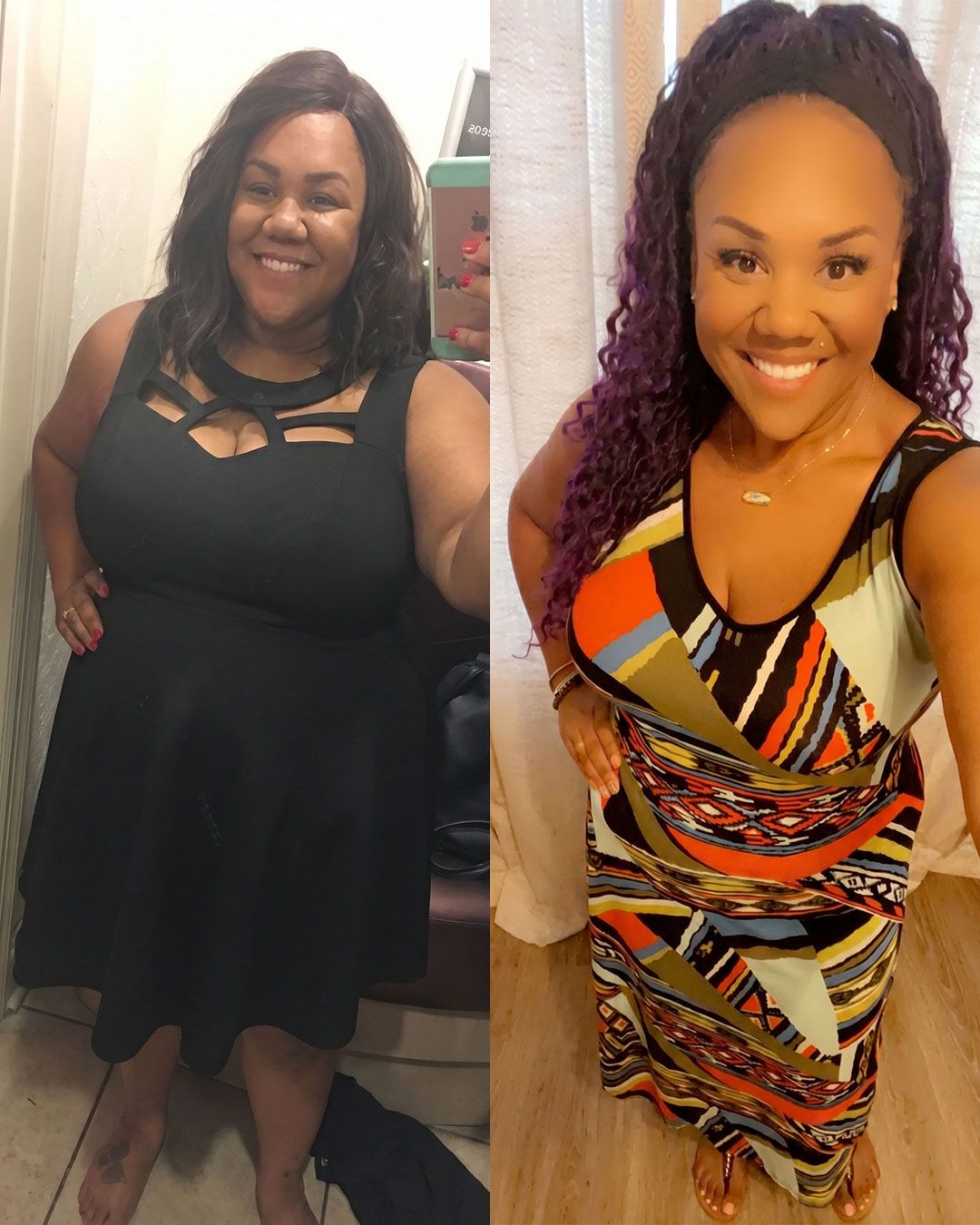 A weight loss patient before (left) and after (right) weight loss.