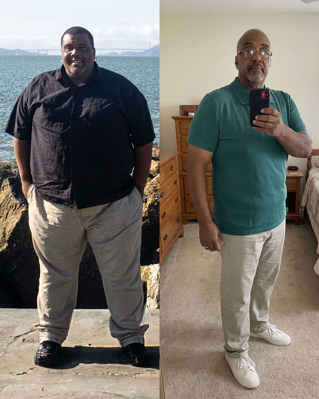 A weight loss patient before (left) and after (right) weight loss.